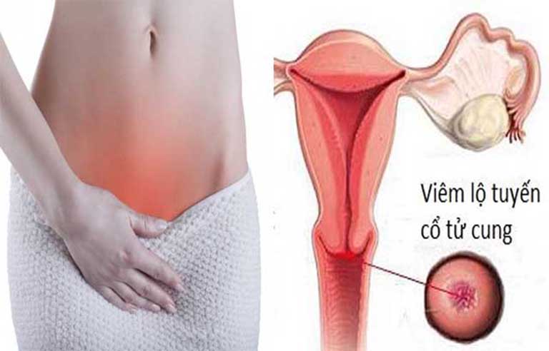 Tìm hiểu về bệnh viêm lộ tuyến tử cung